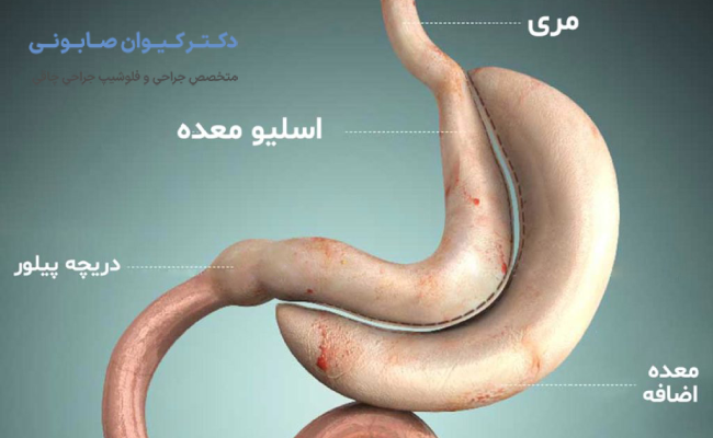 اسلیو معده چیست؟