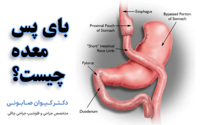 بای پس معده چیست؟