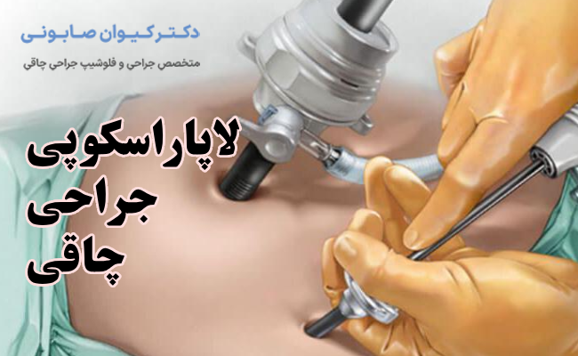 لاپاراسکوپی جراحی چاقی در سنندج