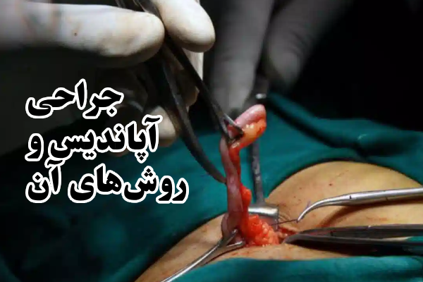 آپاندیس چیست؟