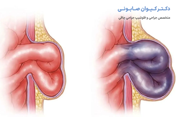 راههای درمان فتق شکم چیست؟
