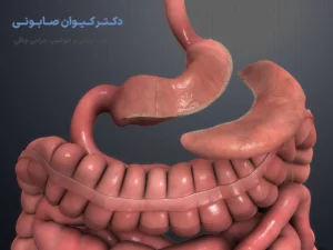 عمل مینی بای پس معده