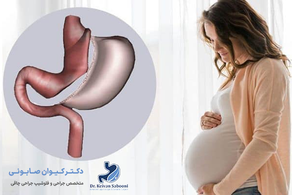 مهم ترین شرایط برای بارداری بعد از اسلیو معده