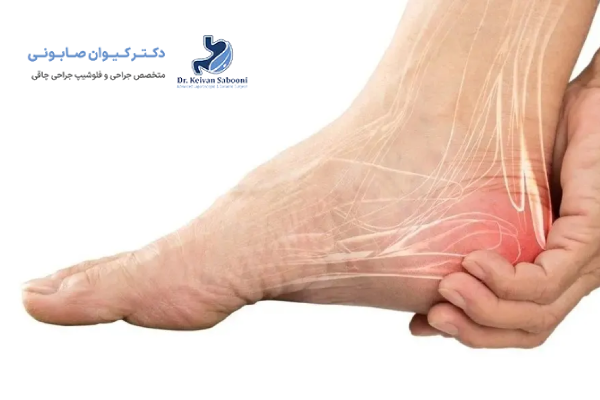 بررسی عوارض عضلانی بعد از عمل اسلیو معده