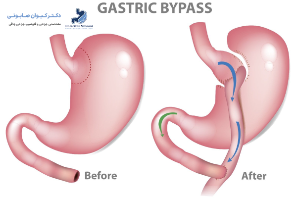 سکسکه چیست؟