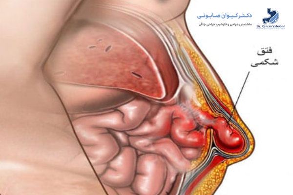 لاپاراسکوپی فتق چه عوارضی ممکن است ایجاد کند؟