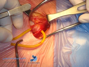 مراحل انجام لاپاراسکوپی فتق؛ از تشخیص تا درمان