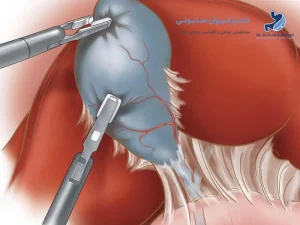 مراقبتهای بعد از جراحی کیسه صفرا | نکاتی که نباید نادیده بگیرید!