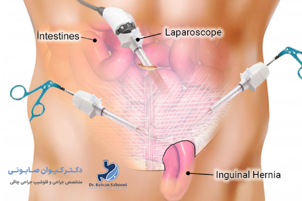 مزایای درمان فتق با لاپاراسکوپی چیست؟