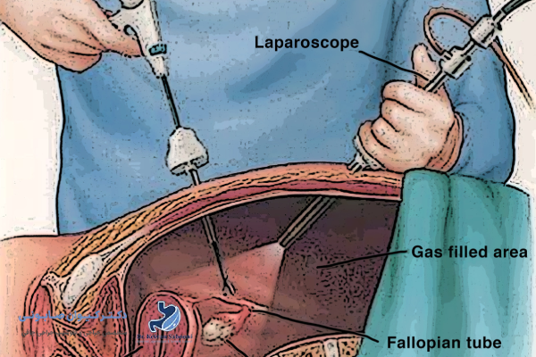 چه کسانی میتوانند لاپاراسکوپی فتق انجام دهند؟