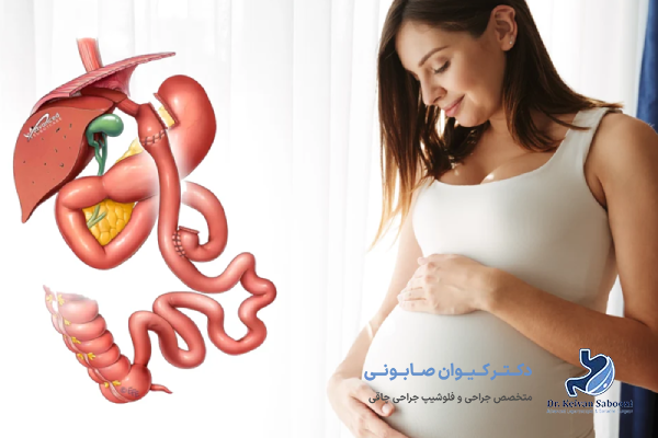 آیا بارداری بعد از عمل بای پس معده امکان پذیر است؟
