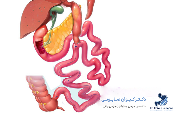 بای پس روده یا دئودنال سوئیچ چیست؟