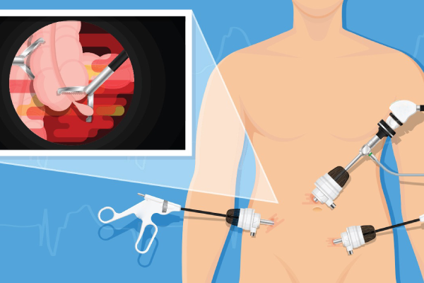 تفاوت مراقبتهای جراحی باز و لاپاراسکوپی