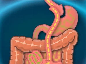 جراحی بای پس روده