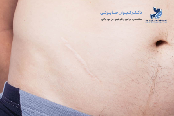 روزهای اول بعد از عمل آپاندیس