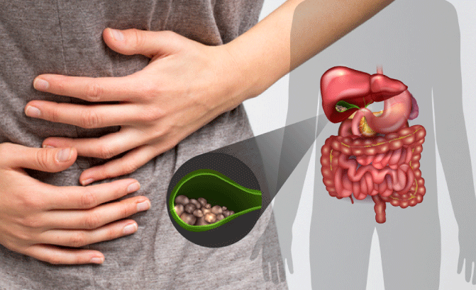 سنگ کیسه صفرا چیست؟