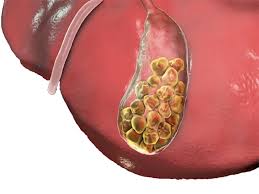 سنگ کیسه صفرا
