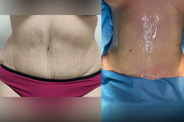 تفاوت اسلیو معده و پیکرتراشی