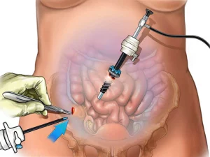 درمان چسبندگی روده با لاپاراسکوپی روده