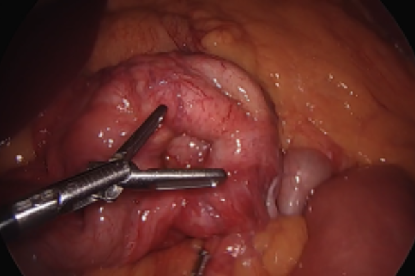 لاپاراسکوپی روده چیست؟