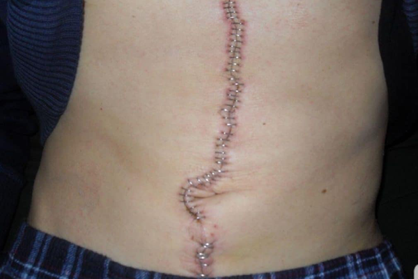 مدت زمان بستری و دوره نقاهت