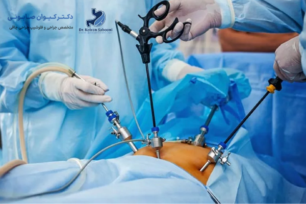 آموزش درباره روند جراحی اسلیو معده