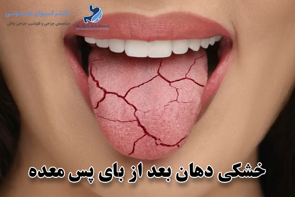 خشکی دهان بعد از بای پس معده