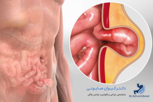 راه های درمان فتق کشاله ران