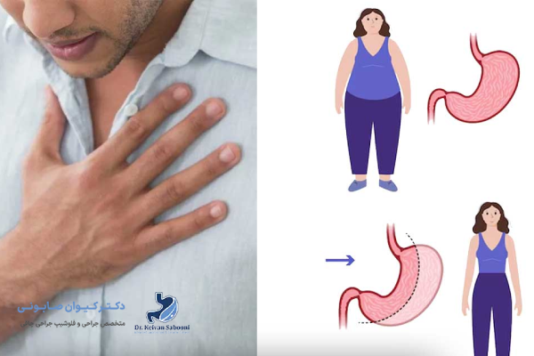 روشهای تشخیص تپش قلب بعد از اسلیو معده