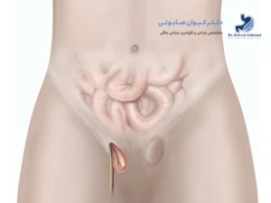 فتق کشاله ران چیست؟ | علائم و خطرات ناشی از آن
