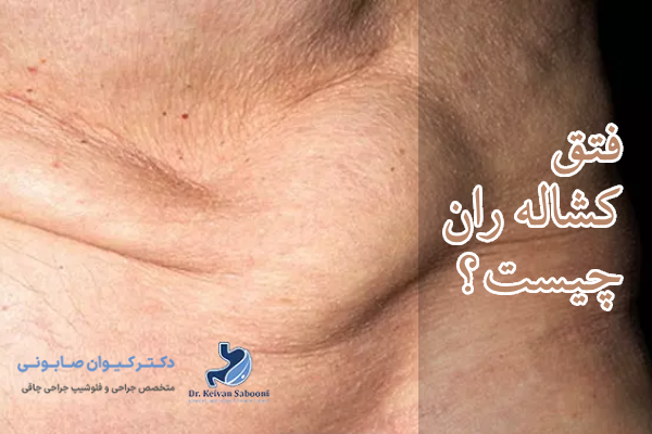 فتق کشاله ران چیست؟