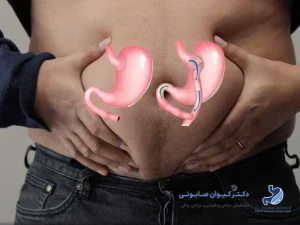 مراقبت‌های بعد از عمل مینی بای پس معده
