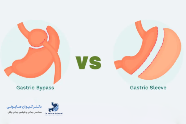 آشنایی کلی با اسلیو معده و بای پس معده