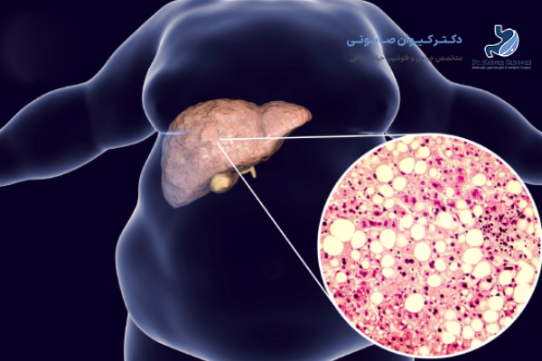 تاثیر جراحی لاغری بر پیشگیری از عوارض کبدی