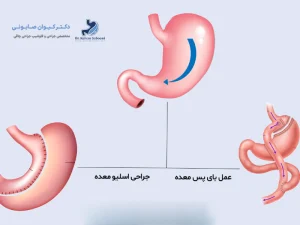 تفاوت بای پس معده و اسلیو معده