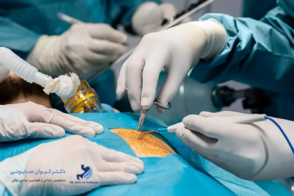 تفاوت بای پس معده و اسلیو معده از نظر مکانیسم عمل