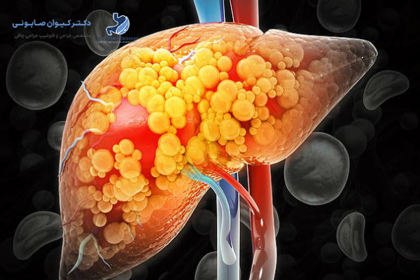 کبد چرب چیست و چگونه ایجاد میشود؟