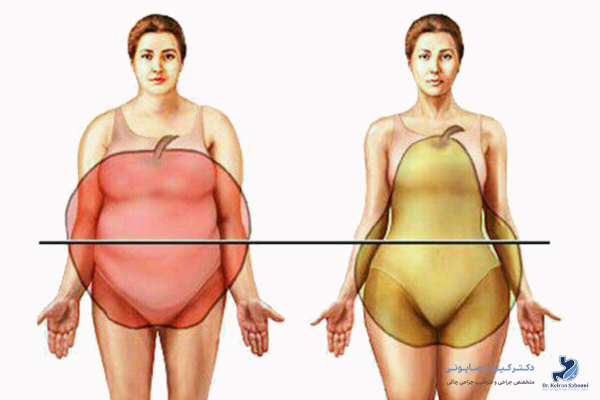 انواع چاقی در بدن زنان و مردان
