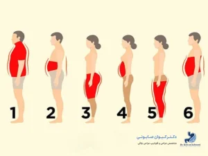 درمان انواع چاقی