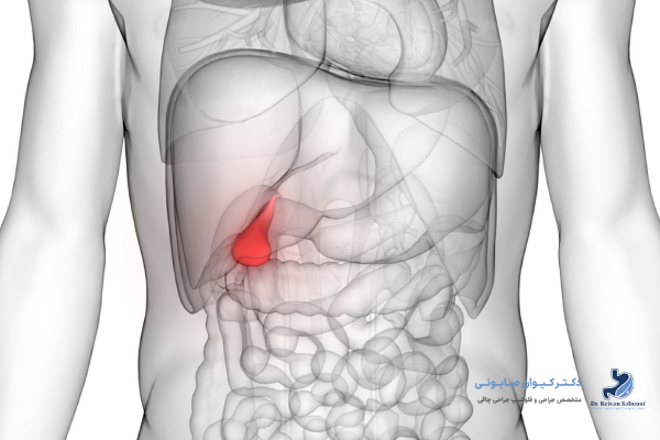 عوامل موثر بر شدت لاغری بعد از دفع سنگ صفرا