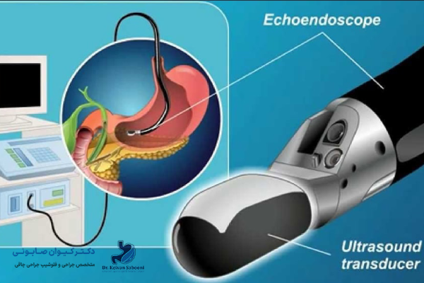 مراحل انجام آندوسکوپی قبل از اسلیو معده