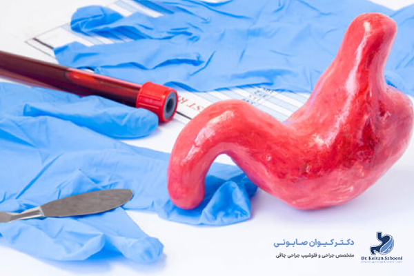 نقش آندوسکوپی در کاهش ریسک نشت معده بعد از اسلیو