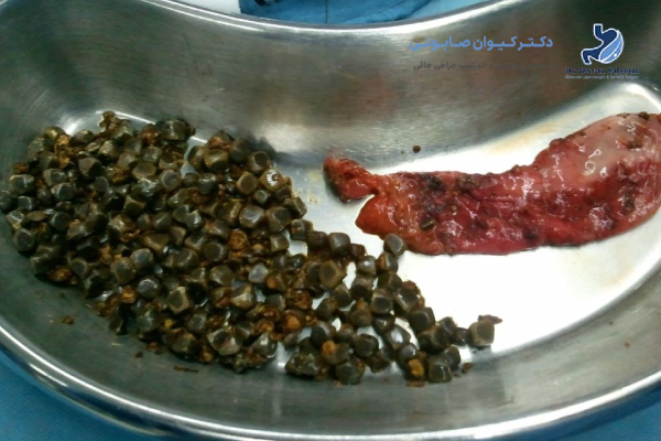 کیسه صفرا چیست و چه نقشی دارد؟