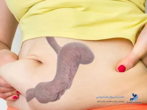گشاد شدن معده بعد از بای پس