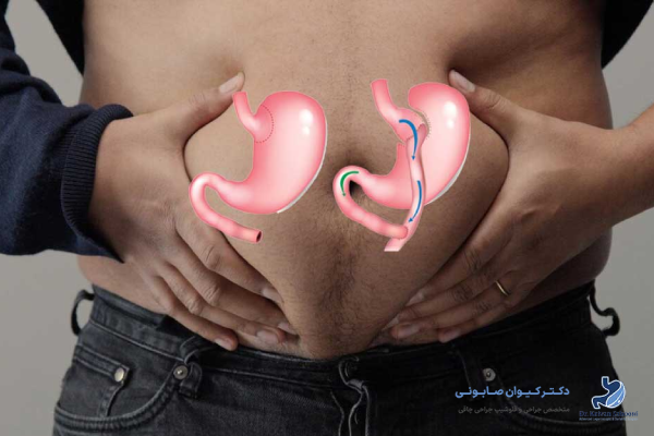 اهداف اصلی رژیم غذایی پس از بایپس معده