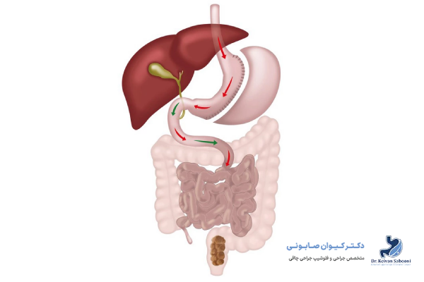 داروهای ملین و مکملهای کمکی برای مدیریت یبوست بعد از اسلیو