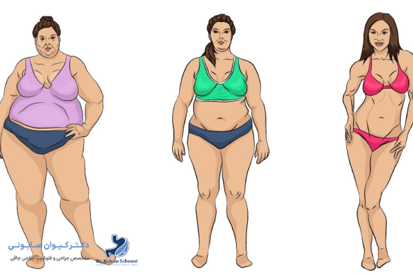 مزایای انجام جراحیهای لاغری با هزینه کمتر