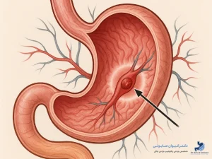 آمبولی بعد از اسلیو معده