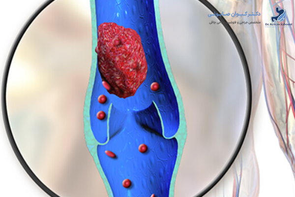 آمبولی چیست و چرا بعد از اسلیو معده اهمیت دارد؟