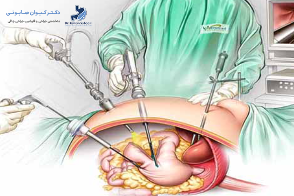 آیا انجام اسلیو معده در سنندج مقرون به صرفه است؟